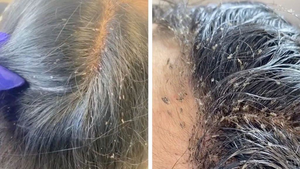 Some Of The Fun Facts About Hair Lice And Its Life Cycle